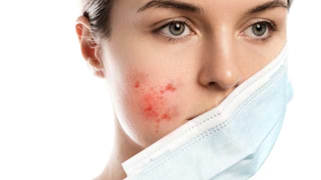 If acne wasn’t enough of a problem already, now we have to deal with maskne, i.e., mask + acne too. Maskne refers to the breakouts that crop up along the lines where we wear face masks. Here’s how to tackle this. 